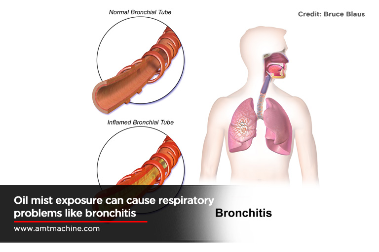 Oil mist exposure can cause respiratory problems like bronchitis